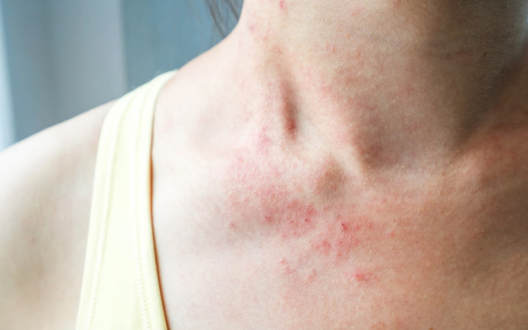 Eczéma : Signification spirituelle et émotions cachées